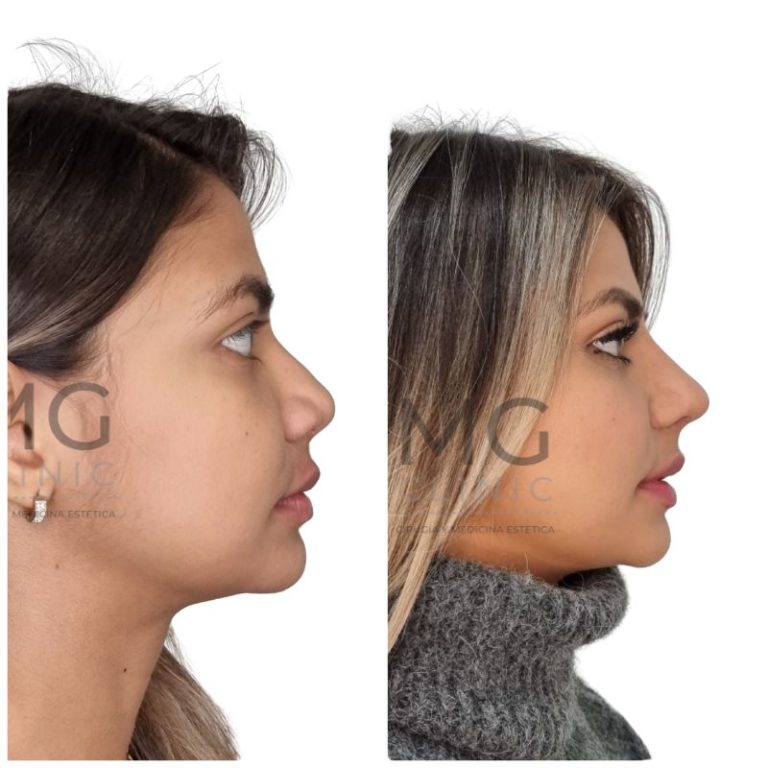 Antes y después de rinoplastia con la Dra. Nancy Miranda 39