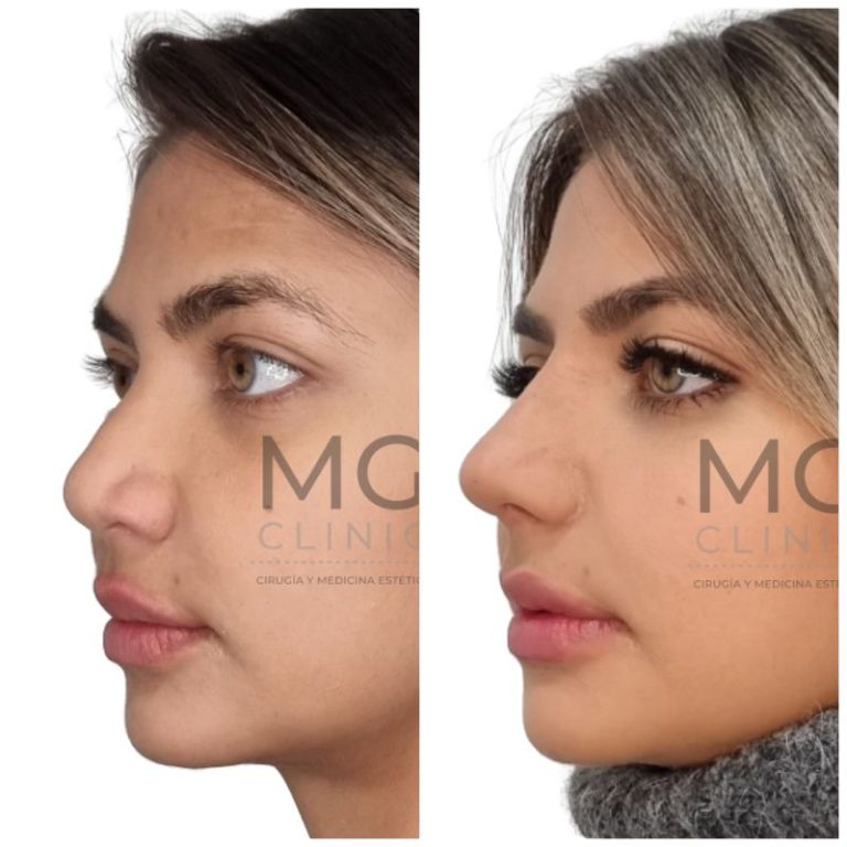 Antes y después de rinoplastia con la Dra. Nancy Miranda 42