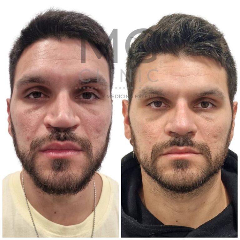 Antes y después de rinoplastia con la Dra. Nancy Miranda 44