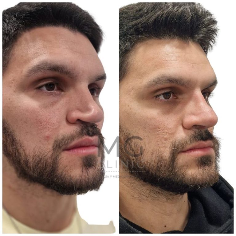 Antes y después de rinoplastia con la Dra. Nancy Miranda 86