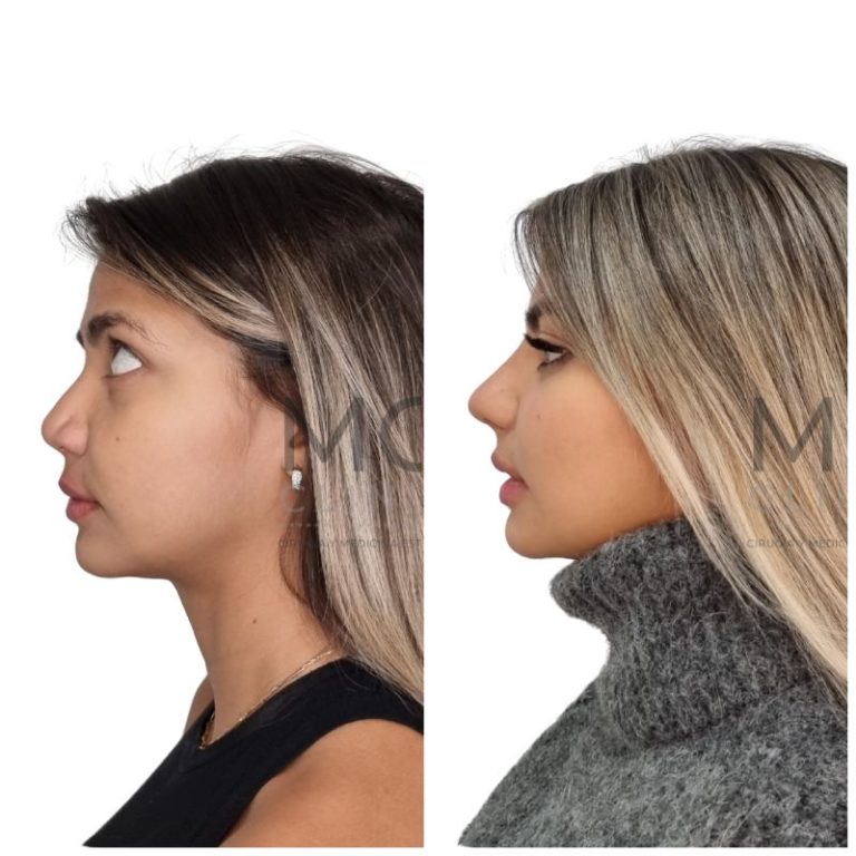 Antes y después de rinoplastia con la Dra. Nancy Miranda 87