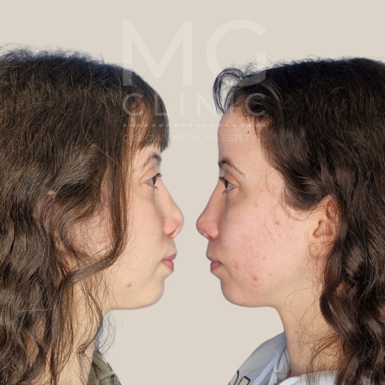 Antes y después de rinoplastia con la Dra. Nancy Miranda Rino secundaria