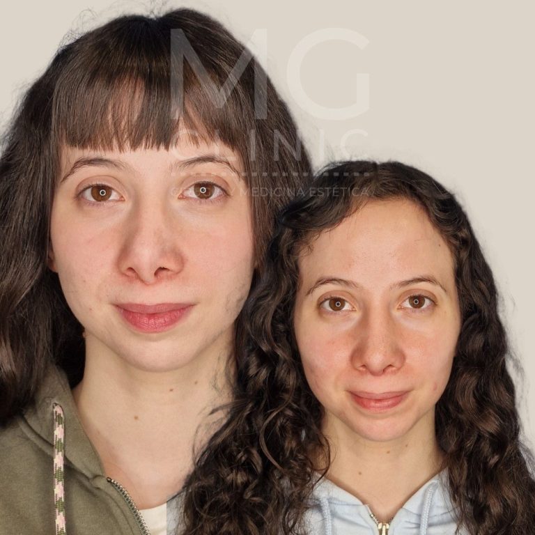 Antes y después de rinoplastia con la Dra. Nancy Miranda Rino secundaria (1)