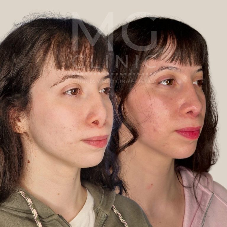 Antes y después de rinoplastia con la Dra. Nancy Miranda Rino secundaria (2)