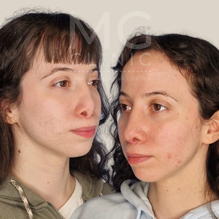 Antes y después de rinoplastia con la Dra. Nancy Miranda Rino secundaria (3)