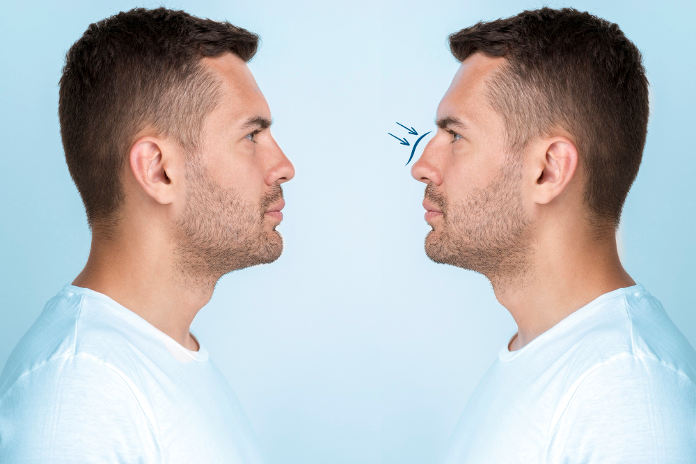 Rinoplastia masculina: cómo mejorar el perfil manteniendo los rasgos del paciente Rinoplastia masculina: cómo mejorar el perfil manteniendo los rasgos del paciente